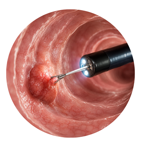 Diagnostic Endoscopy- Histopathological Biopsy